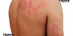 Aumentó tasa de vacunación contra el herpes zóster durante la pandemia por Covid-19