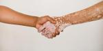 Sensibiliza Secretaría de Salud en el día del vitiligo
