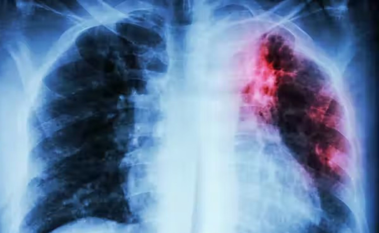 Avanza programa binacional contra la tuberculosis