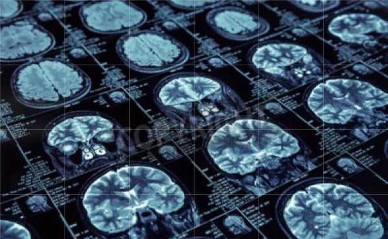 Divulga ISSSTECALI sintomatología de encefalitis para atenderla a tiempo