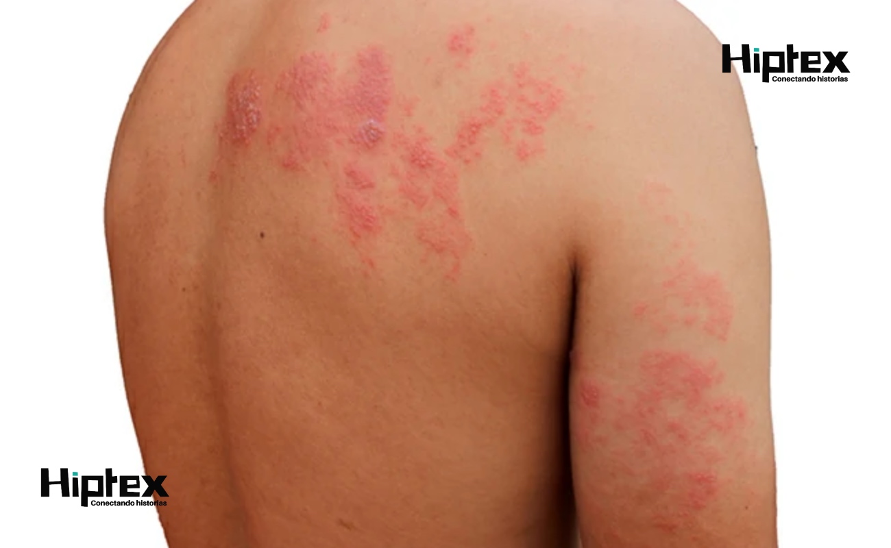 Aumentó tasa de vacunación contra el herpes zóster durante la pandemia por Covid-19