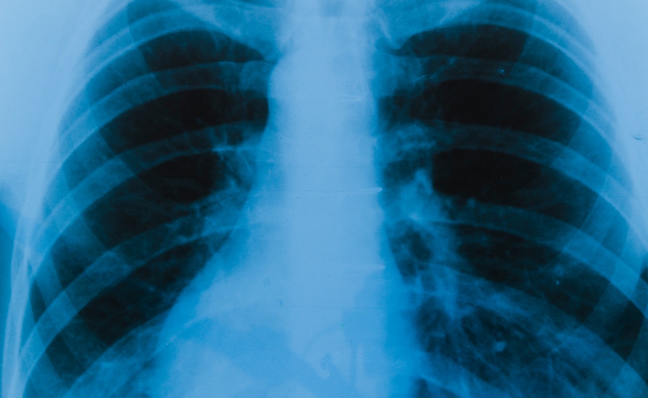 Fribosis pulmonar, una enfermedad con daños irreversibles