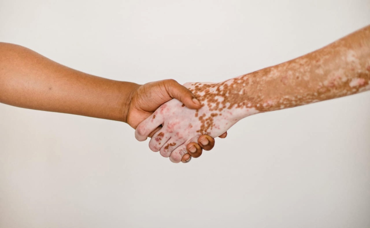 Sensibiliza Secretaría de Salud en el día del vitiligo