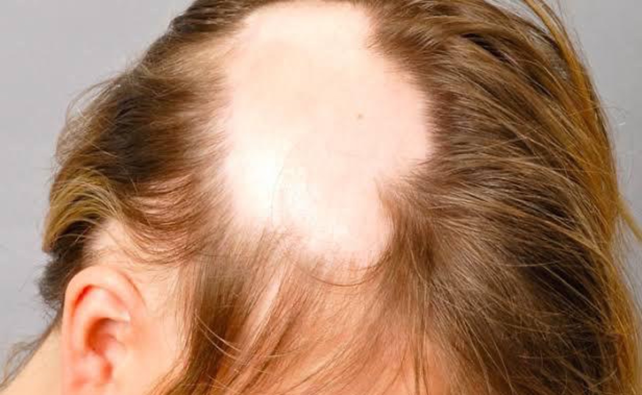 Pueden mujeres con alopecia experimentar trastornos emocionales graves