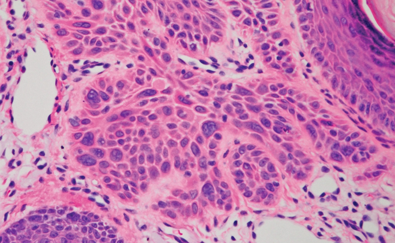 Estudio mexicano revela detalles inéditos del melanoma acral y su relación con el origen genético de los pacientes