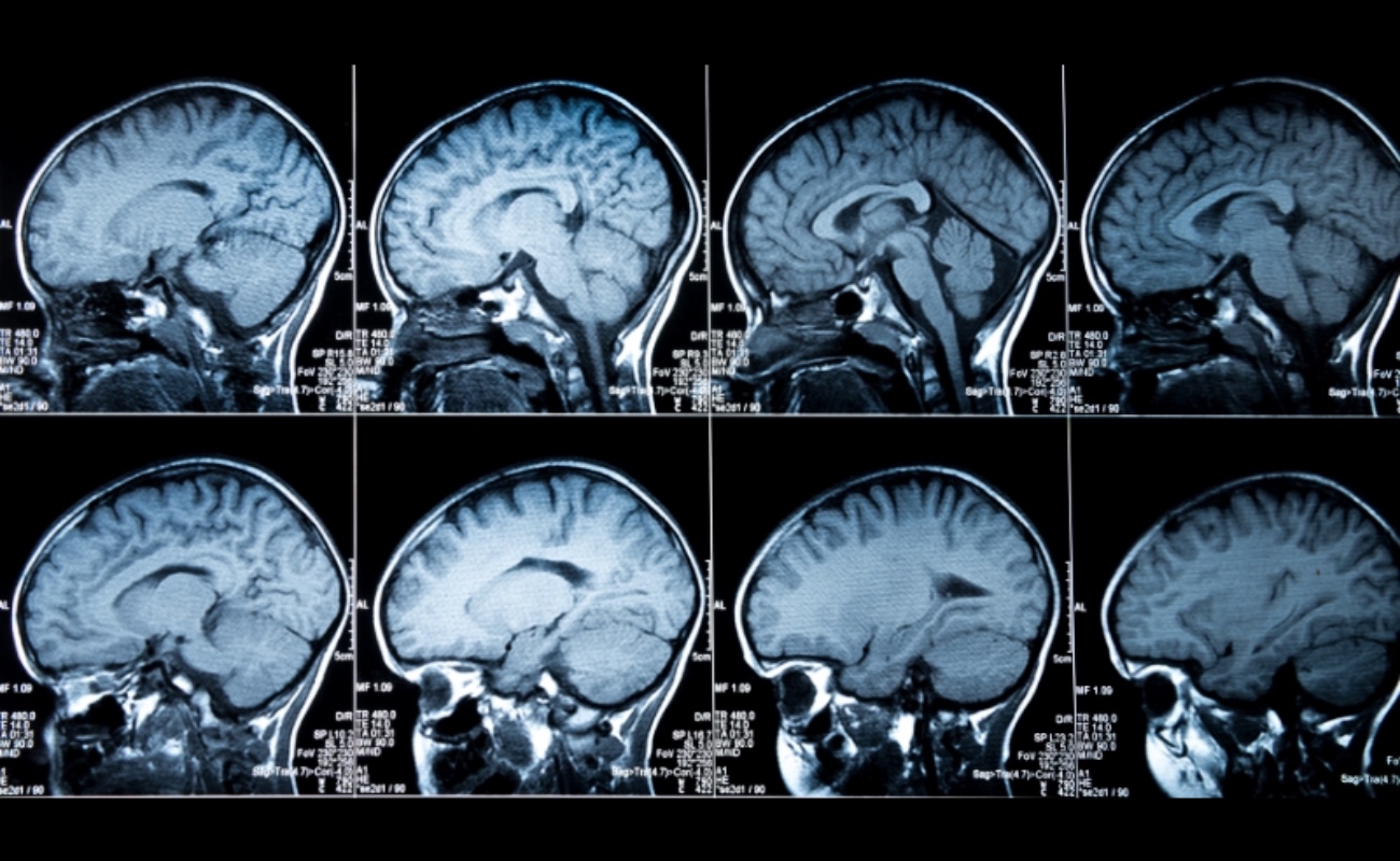 Científicos crean mapas moleculares de alta resolución del Alzheimer