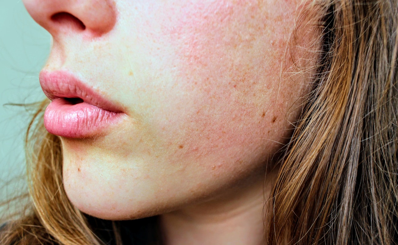 Los niños son vulnerables a dermatitis y alergias al jugar con agua encharcada por lluvias.